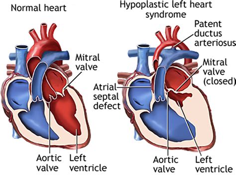 hypoplastic left heart syndrome prognosis